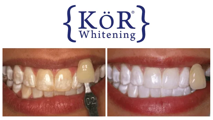 KOR Whitening Results