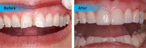 Dental Bridges in Northbrook