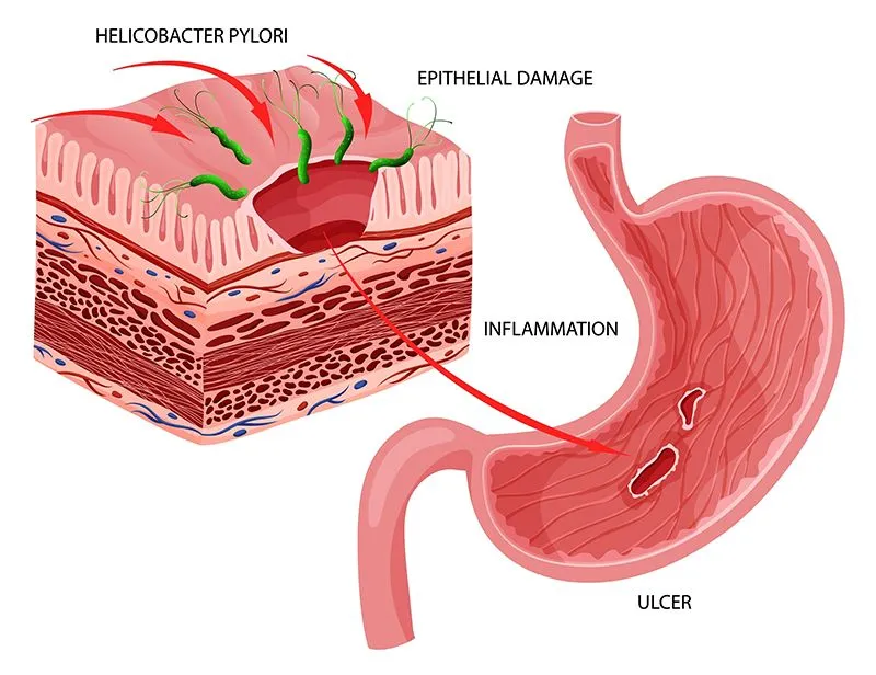 Medical illustration of Helicobacter pylori bacteria damaging stomach epithelial cells.