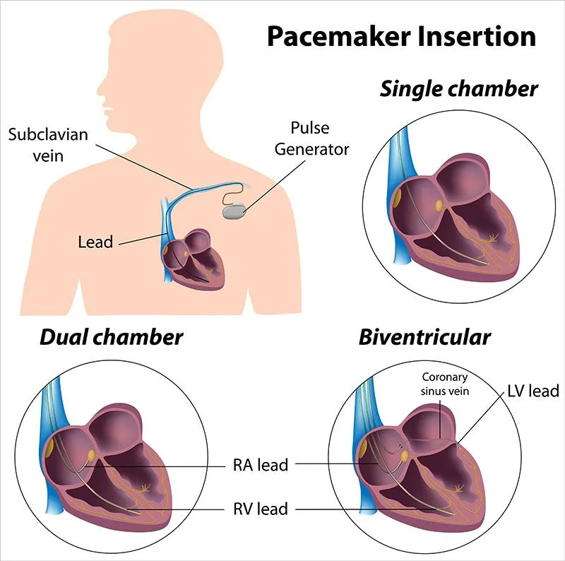 pacemakter insertion