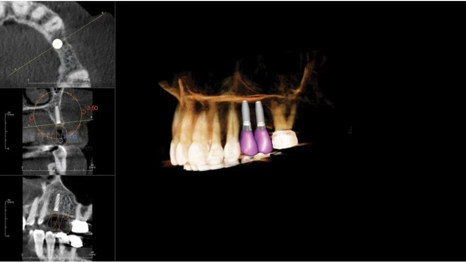 CBCT