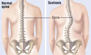 chiropractic for scoliosis