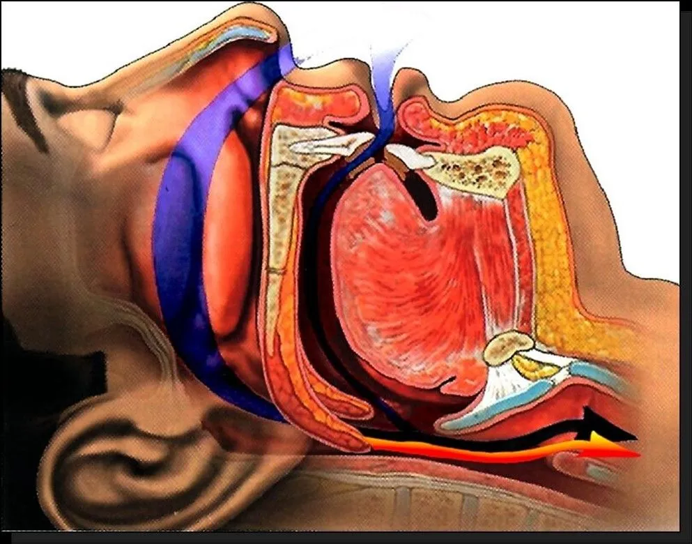 illustration of head and throat showing obstructed breathing causing snoring Syracuse, NY