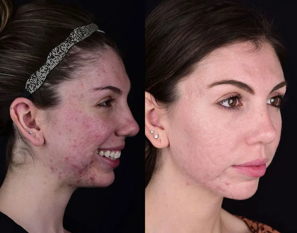 skin rejuvenation before and after 1