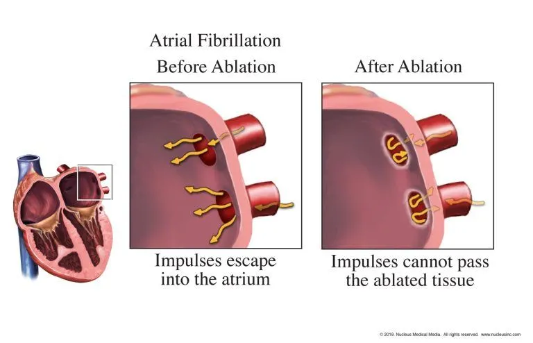 afib ablation