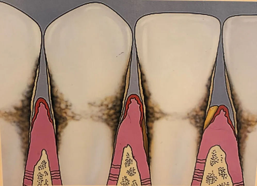 Gum Disease in Reston, VA