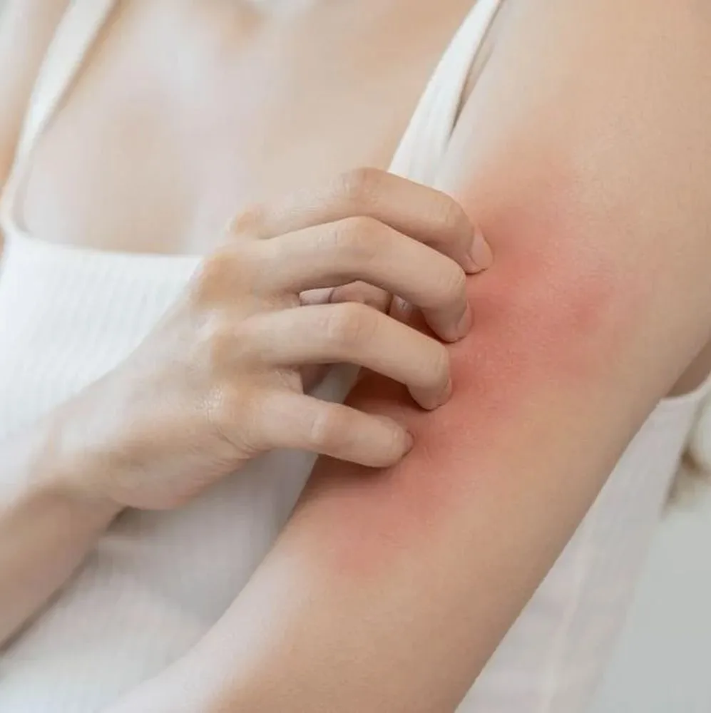 arm with rash