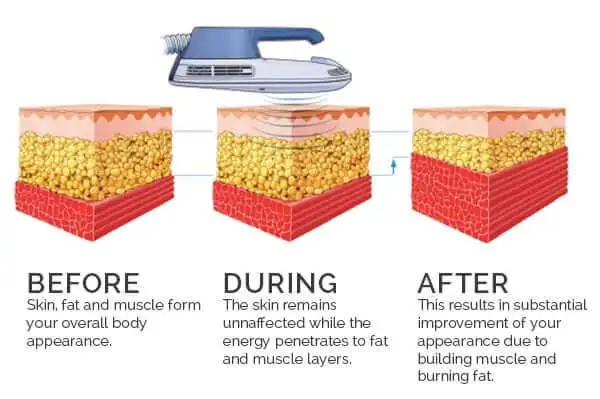 emsculpt1